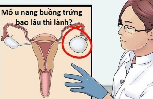 Mổ u nang buồng trứng bao lâu thì lành?